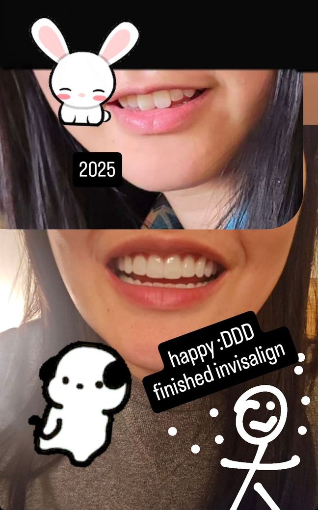 Before and after of Wing's teeth (Invisalign). The top picture shows bunny front incisors which were butterfly angled. The bottom shows perfect teeth after alignment,  whitening and cosmetic bonding.